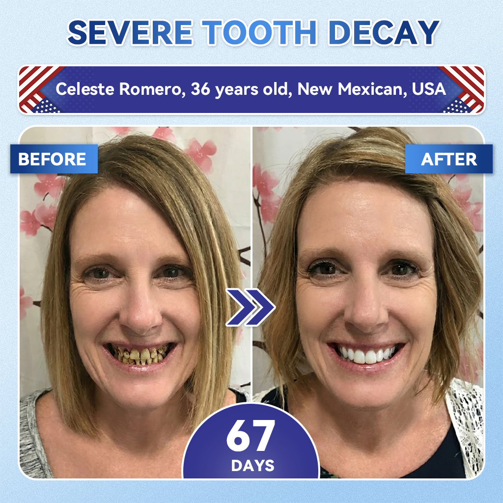 Smile instantly 🦷 𝐺𝑙𝑖𝑚𝑚𝑒𝑟𝑙𝑦®⭐⭐ 𝑇𝑖𝑑𝑒𝑔𝑙𝑢𝑠𝑖𝑏 𝑇𝑜𝑜𝑡ℎ & 𝐺𝑢𝑚 𝑅𝑒𝑝𝑎𝑖𝑟 𝐹𝑎𝑠𝑡-𝐷𝑖𝑠𝑠𝑜𝑙𝑣𝑖𝑛𝑔 𝑊ℎ𝑖𝑡𝑒𝑛𝑖𝑛𝑔 𝑆𝑡𝑟𝑖𝑝𝑠  (𝟓-𝐢𝐧-𝟏 💎 𝐑𝐞𝐛𝐮𝐢𝐥𝐝 𝐄𝐧𝐚𝐦𝐞𝐥 & 𝐃𝐞𝐧𝐭𝐢𝐧 • 𝐒𝐭𝐫𝐞𝐧𝐠𝐭𝐡𝐞𝐧 𝐆𝐮𝐦𝐬 • 𝐄𝐫𝐚𝐝𝐢𝐜𝐚𝐭𝐞 𝐓𝐚𝐫𝐭𝐚𝐫 & 𝐎𝐝𝐨𝐫 • 𝐖𝐡𝐢𝐭𝐞𝐧𝐢𝐧𝐠 • 𝐒𝐭𝐨𝐩 𝐓𝐨𝐨𝐭𝐡 𝐒𝐞𝐧𝐬𝐢𝐭𝐢𝐯𝐢𝐭𝐲)