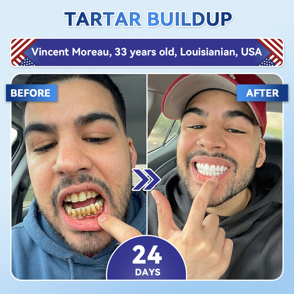 Smile instantly 🦷 𝐺𝑙𝑖𝑚𝑚𝑒𝑟𝑙𝑦®⭐⭐ 𝑇𝑖𝑑𝑒𝑔𝑙𝑢𝑠𝑖𝑏 𝑇𝑜𝑜𝑡ℎ & 𝐺𝑢𝑚 𝑅𝑒𝑝𝑎𝑖𝑟 𝐹𝑎𝑠𝑡-𝐷𝑖𝑠𝑠𝑜𝑙𝑣𝑖𝑛𝑔 𝑊ℎ𝑖𝑡𝑒𝑛𝑖𝑛𝑔 𝑆𝑡𝑟𝑖𝑝𝑠  (𝟓-𝐢𝐧-𝟏 💎 𝐑𝐞𝐛𝐮𝐢𝐥𝐝 𝐄𝐧𝐚𝐦𝐞𝐥 & 𝐃𝐞𝐧𝐭𝐢𝐧 • 𝐒𝐭𝐫𝐞𝐧𝐠𝐭𝐡𝐞𝐧 𝐆𝐮𝐦𝐬 • 𝐄𝐫𝐚𝐝𝐢𝐜𝐚𝐭𝐞 𝐓𝐚𝐫𝐭𝐚𝐫 & 𝐎𝐝𝐨𝐫 • 𝐖𝐡𝐢𝐭𝐞𝐧𝐢𝐧𝐠 • 𝐒𝐭𝐨𝐩 𝐓𝐨𝐨𝐭𝐡 𝐒𝐞𝐧𝐬𝐢𝐭𝐢𝐯𝐢𝐭𝐲)